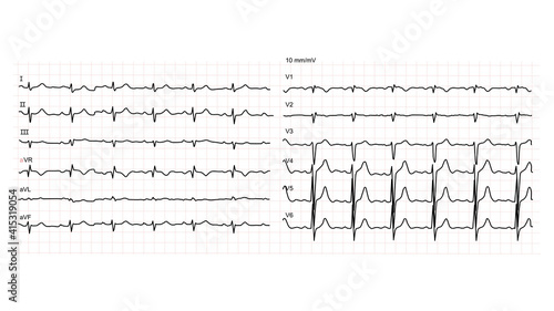 Illustration of normal electrocardiogram 12 leads on white background.