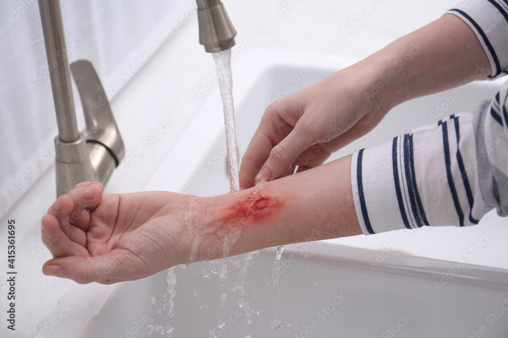 Woman holding forearm with burn under flowing water indoors, closeup Woman holding forearm with burn under flowing water indoors, closeup