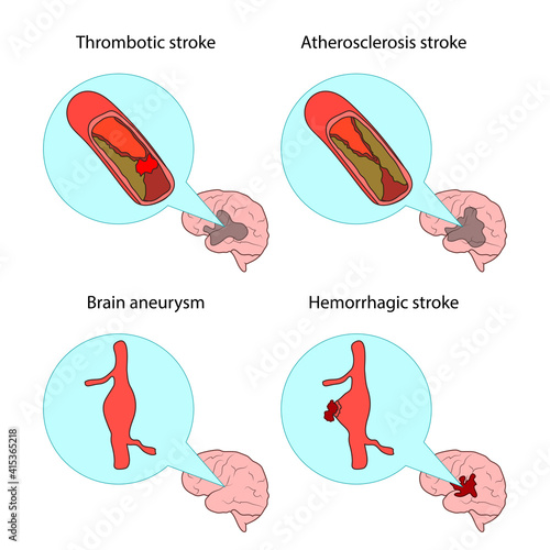 Types of stroke. Thrombotic, Atherosclerosis, Hemorrhagic stroke, brain aneurysm. Medical illustration.