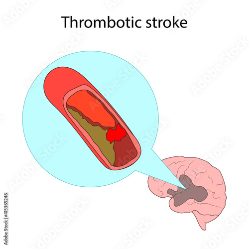 Types of stroke. Thrombotic. Brain disease. Medical illustration.