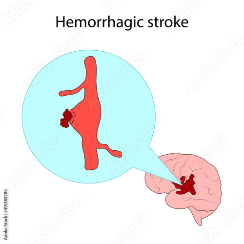 Types of stroke. Hemorrhagic stroke, brain aneurysm. Medical illustration.