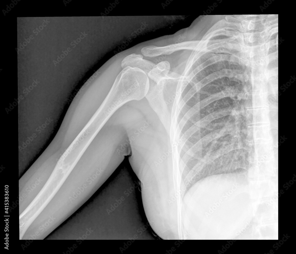 xray shoulder radiograph displaying Acromioclavicular sprain