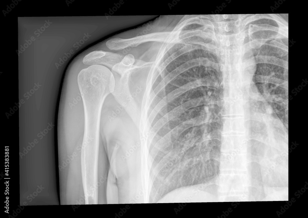 xray shoulder radiograph displaying Acromioclavicular sprain