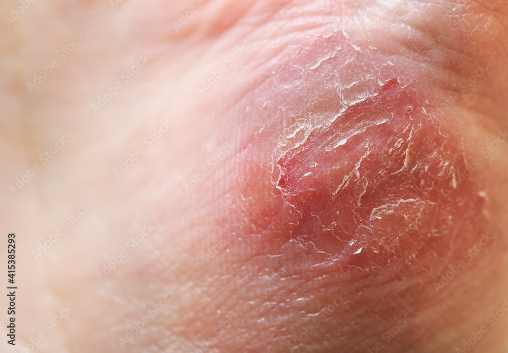 Atopic dermatitis (AD), also known as atopic eczema, is a type of skin inflammation (dermatitis) on the hand. Atopic dermatitis (AD), also known as atopic eczema, is a type of skin inflammation (dermatitis) on the hand.