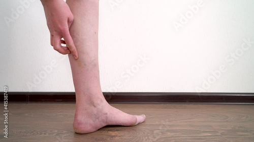 Woman's leg with varicose veins close-up. photo