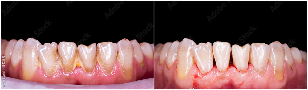 Obraz premium teeth cleaning before and after picture
