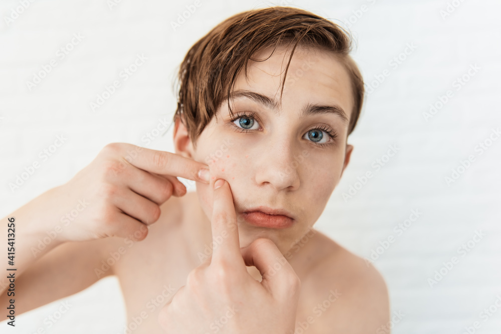 Teen boy with red pimples on on his face, closeup. Acne and skin problem Teen boy with red pimples on on his face, closeup. Acne and skin problem