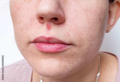 Cold sore or herpes under the nose of a young woman.  photo