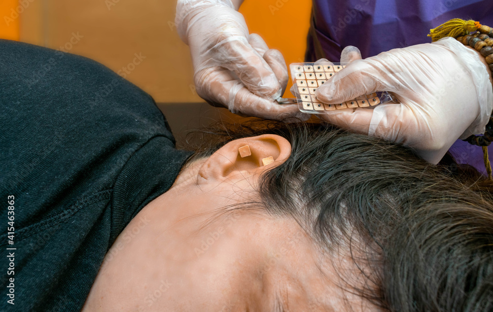  terapeuta de auriculoterapia poniendo agujas , semillas y chinchetas en la oreja de una paciente durante  una sesión de auriculoterapia . - obrazy, fototapety, plakaty 