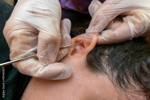  terapeuta de auriculoterapia poniendo agujas , semillas y chinchetas en la oreja de una paciente durante  una sesión de auriculoterapia .
