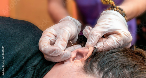  terapeuta de auriculoterapia poniendo agujas , semillas y chinchetas en la oreja de una paciente durante una sesión de auriculoterapia .