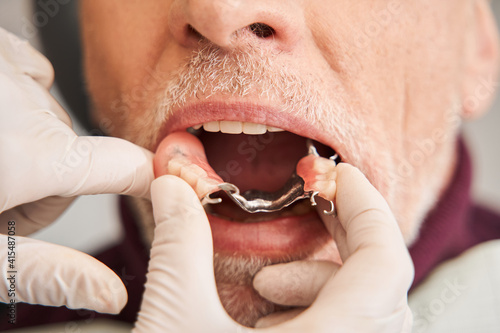 Dentist putting in artificial teeth to patient mouth © Yakobchuk Olena