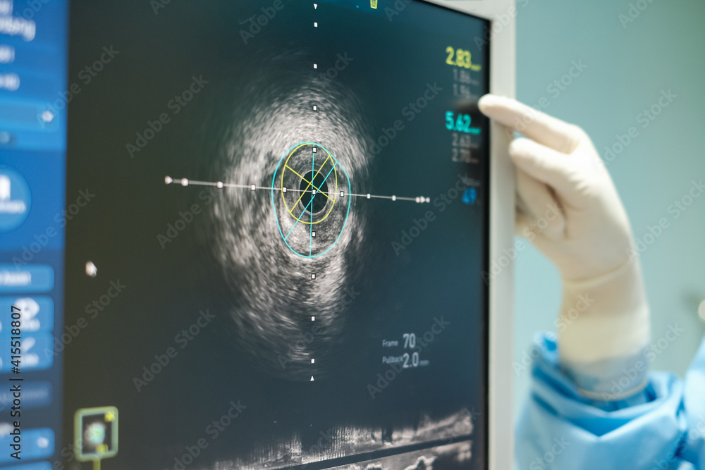 Intravascular ultrasound imaging (IVUS) at cardiac catheterization ...