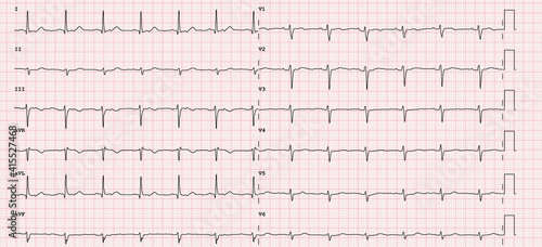 Canvastavla ECG example of a normal 12-lead sinus rhythm
