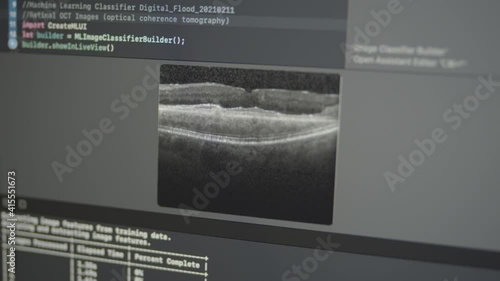 2.41 Real Neural Network Machine Learning Analyzes Retinal Optical Coherence Tomography OCT Images Detect Drusen, Diabetic Macular Edema, Choroidal Neovascularization