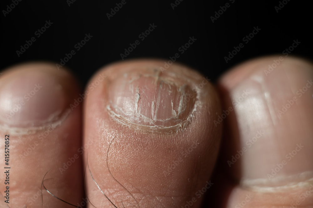 Close-up of male toes with a cracked nail Close-up of male toes with a cracked nail