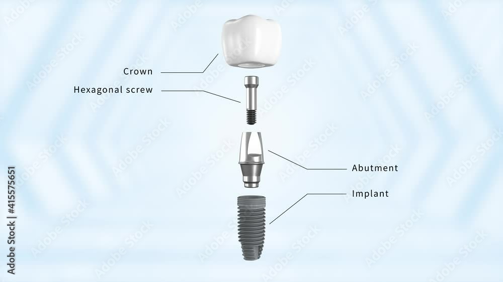 Titanium alloy implant structure description