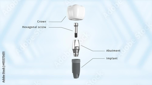 Titanium alloy implant structure description
