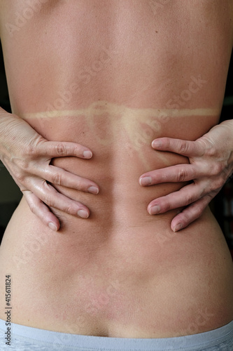 Back of Caucasian woman with red skin and bikini print after sunbathing on the beach. 
