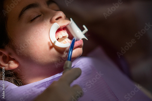Applying braces for teeth to a cute little girl in dentist studio, patient wearing a mouth opening tool