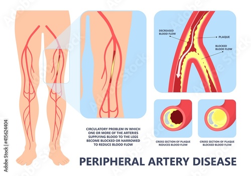 Graft artery PAD flow legs pain fatty treat hips Calf toes feet High heart ABI foot test Ankle clot injury arms stent veins Sores index attack venous ulcers blood limbs