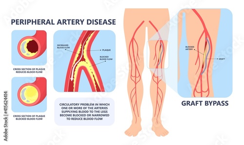 Graft artery PAD flow legs pain fatty treat hips Calf toes feet High heart ABI foot test Ankle clot injury arms stent veins Sores index attack venous ulcers blood limbs photo