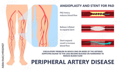 Graft artery PAD flow legs pain fatty treat hips Calf toes feet High heart ABI foot test Ankle clot injury arms stent veins Sores index attack venous ulcers blood limbs