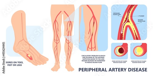 Graft artery PAD flow legs pain fatty treat hips Calf toes feet High heart ABI foot test Ankle clot injury arms stent veins Sores index attack venous ulcers blood limbs