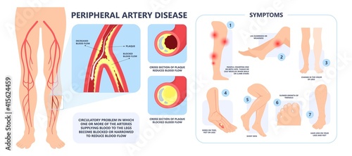 Graft artery PAD flow legs pain fatty treat hips Calf toes feet High heart ABI foot test Ankle clot injury arms stent veins Sores index attack venous ulcers blood limbs