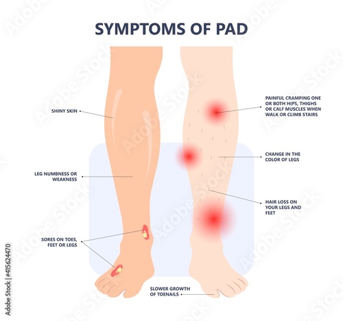 Graft artery PAD flow legs pain fatty treat hips Calf toes feet High heart ABI foot test Ankle clot injury arms stent veins Sores index attack venous ulcers blood limbs