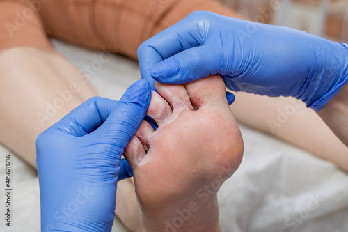 A podiatrist examines a sore foot with hyperhidrosis. Damaged skin with cracks. Medical pedicure in a beauty salon.