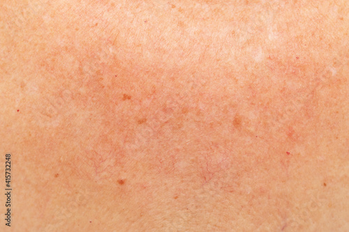 pigmentation on the skin in the neck and chest area as a background
