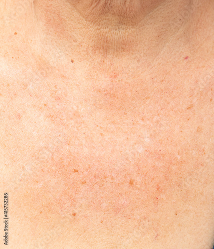 Foto pigmentation on the skin in the neck and chest area as a background
