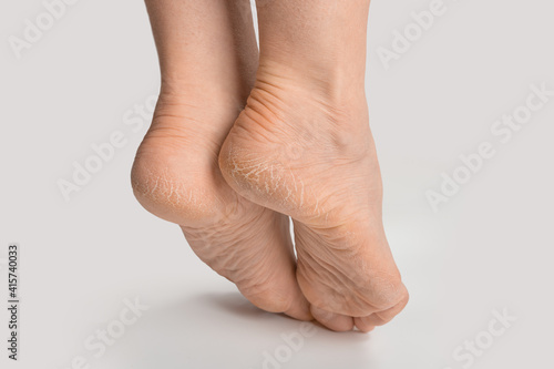 foot with dry skin on heel and sole. women female feet with rough cracked skin isolated on gray background, close up, copyspace