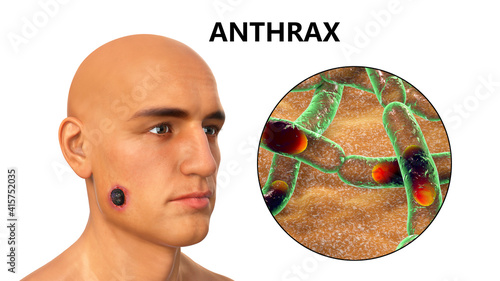 Cutaneous anthrax, the most common form of anthrax photo