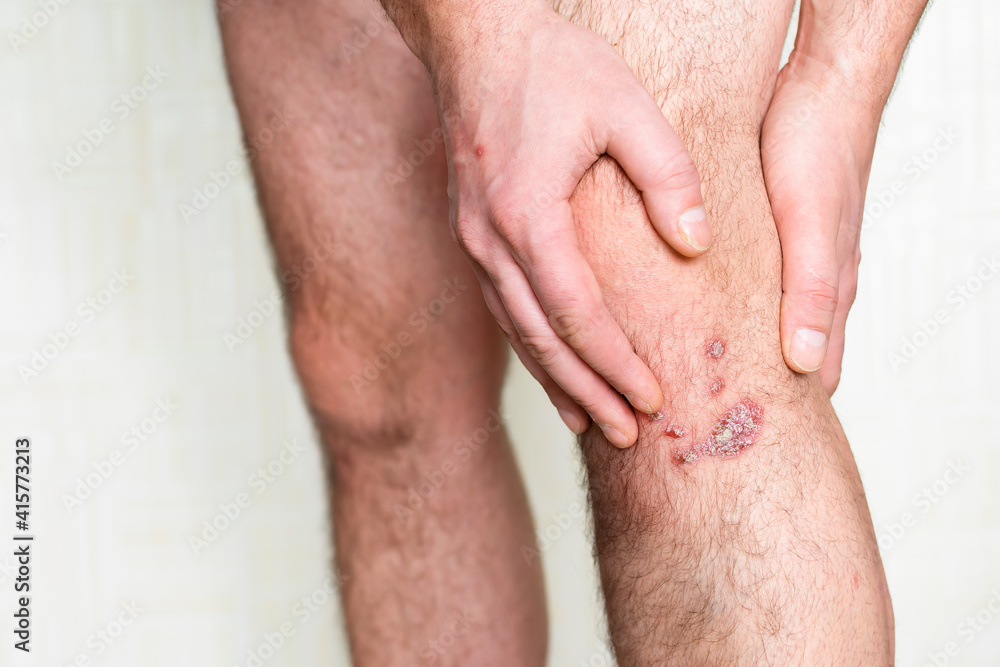 Progressive psoriasis on the knees Progressive psoriasis on the knees