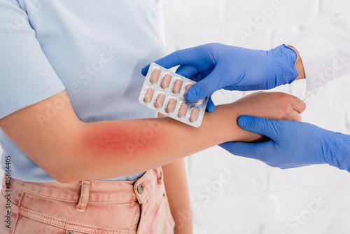 Cropped view of doctor in latex gloves holding pills near woman with allergy redness on arm