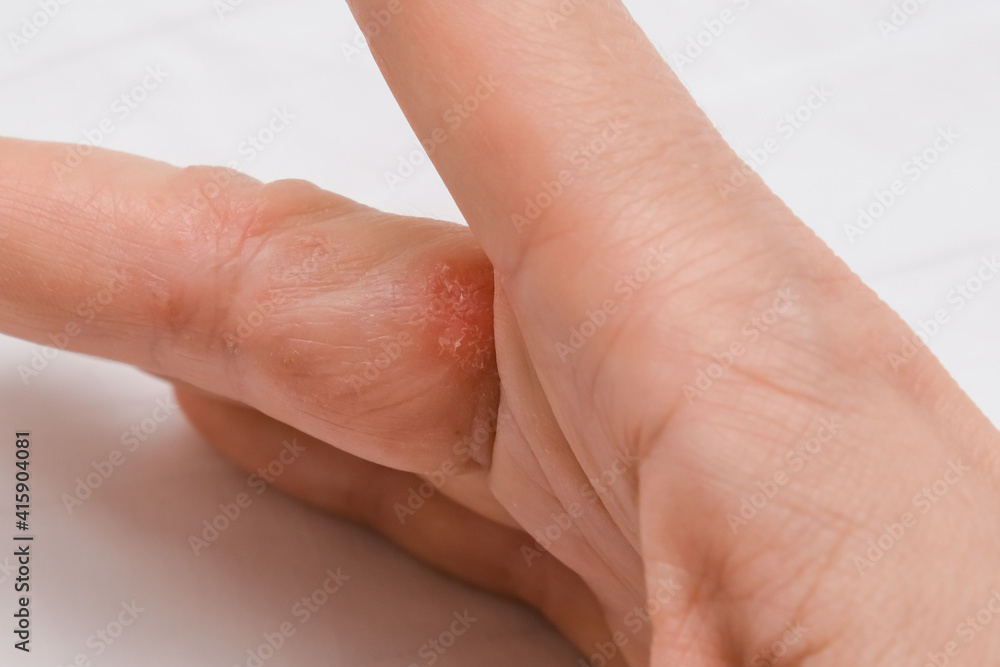Hand with interdigital dermatitis, dyshidrotic eczema on hand close up Hand with interdigital dermatitis, dyshidrotic eczema on hand close up