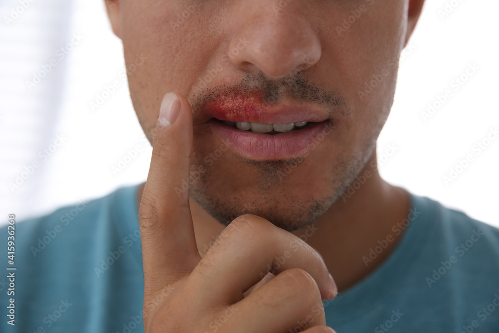 Fototapeta premium Man with herpes touching lips against light background, closeup