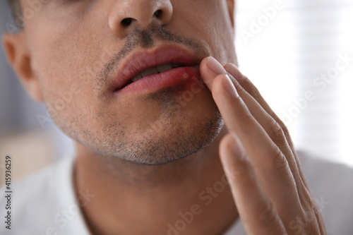 Man with herpes touching lips against blurred background, closeup photo