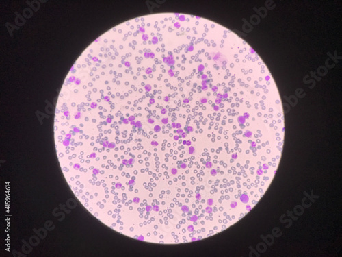 Immature and mature white blood cells.Segmented neutrophil,blast cells myelocyte,metamyelocyte,Band form in blood smear, photo