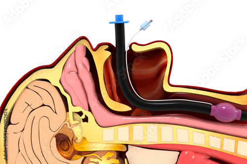 Endotracheal intubation on white background. 3d illustration photo