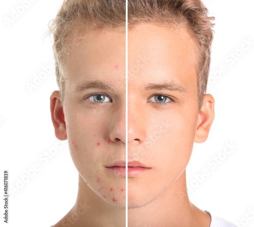 Teenage boy before and after acne treatment on white background