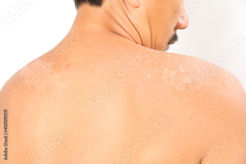 Wallpaper Mural Asian man with sunburned skin and face on white background. Torontodigital.ca