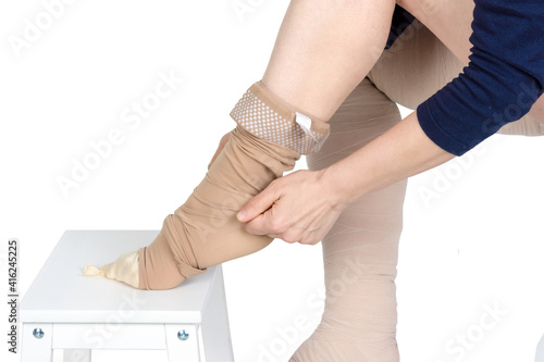 Compression garments for the treatment of lipoedema and lymphoedema.Lymphedema management: Wrapping leg using multilayer bandages to control Lymphedema. Part of complete decongestive therapy (cdt