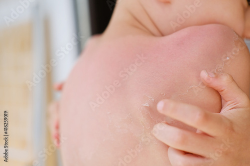 Quadro em tela back of a child with sunburns and peeling dead skin of a 6-7 year old boy with s