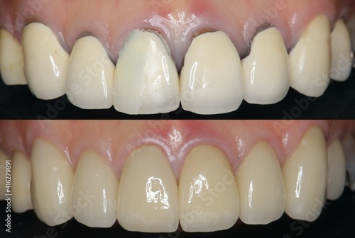 前歯　審美歯科治療
