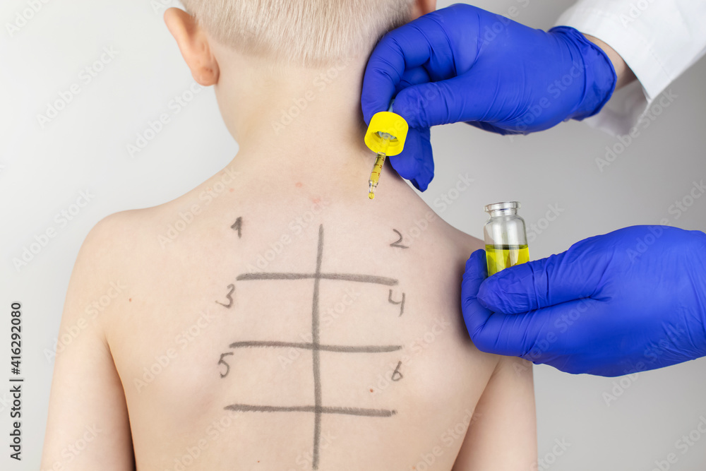 An allergist in the laboratory conducts an allergy pricktest. Skin