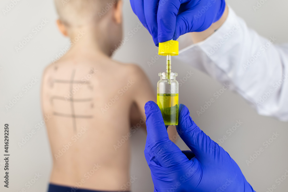 An allergist in the laboratory conducts an allergy pricktest. Skin