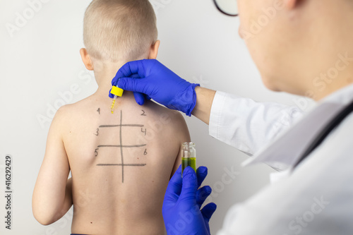 An allergist in the laboratory conducts an allergy prick-test. Skin test for household, food, epidermal allergic reactions. The test is performed on the patient's back. Child at a doctor's appointment